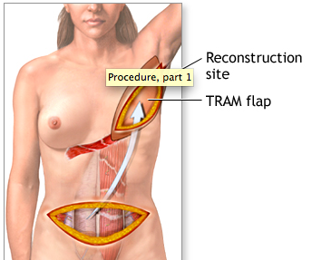Breast reconstruction Best Reconstructive Plastic Surgery India Kolkata: Breast Reconstruction Free Flaps by Dr Srinjoy Saha