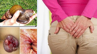 Pengobatan herbal ambeien luar tanpa operasi dan menghilangkan benjolan wasir Pengobatan herbal ambeien luar tanpa operasi dan menghilangkan benjolan wasir, ambeien luar, obat herbal ambeien
