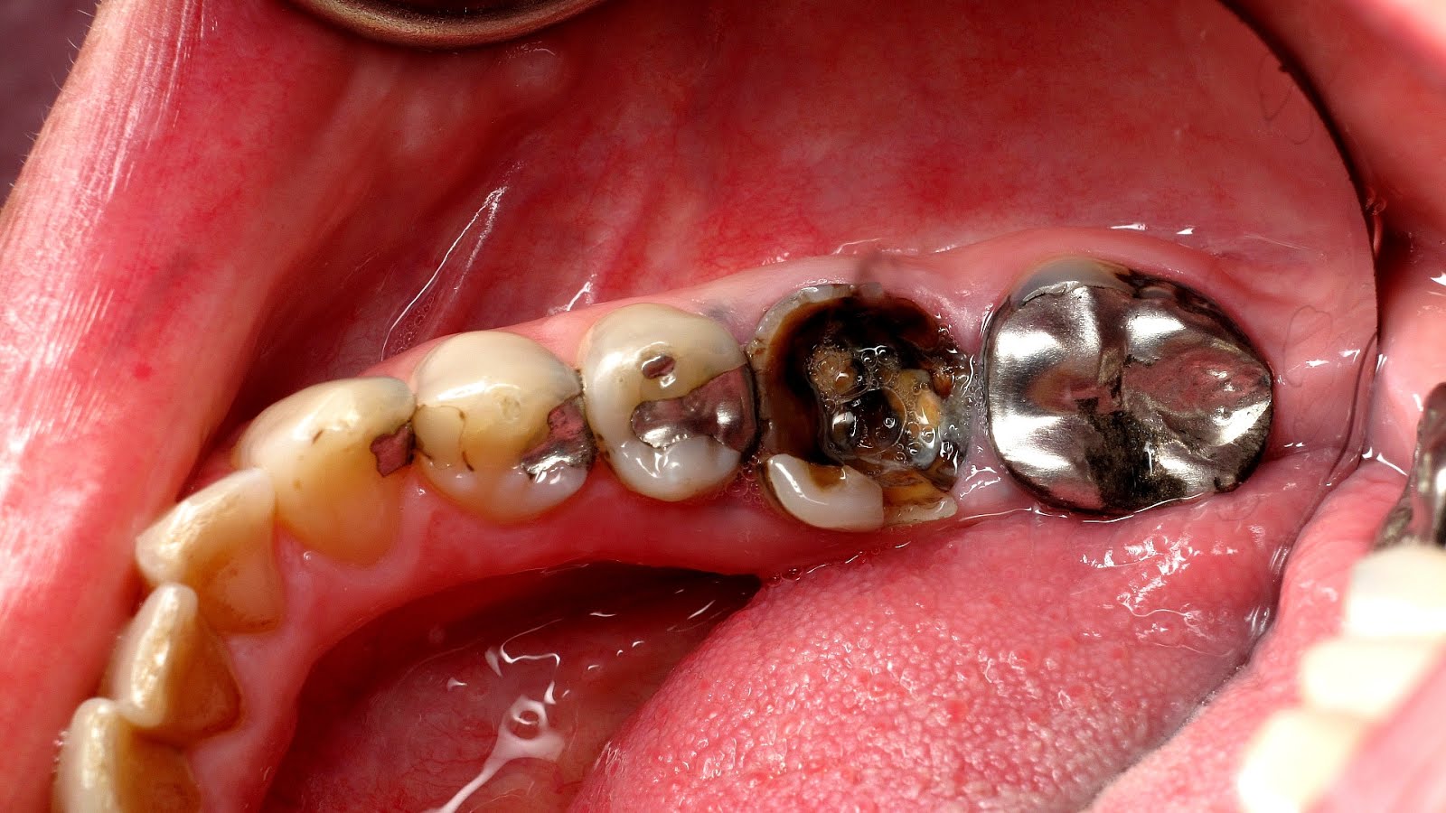 sell gold tooth crown