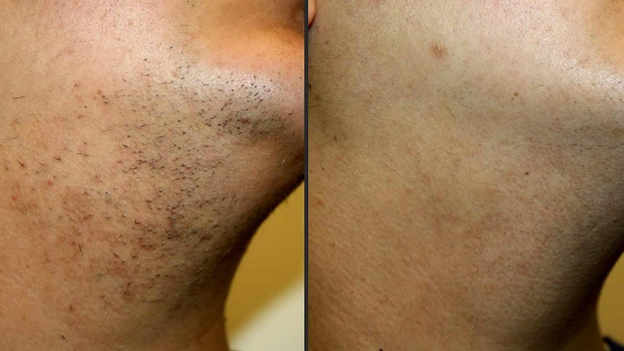 Effectiveness Of Laser Hair Removal Effect Choices
