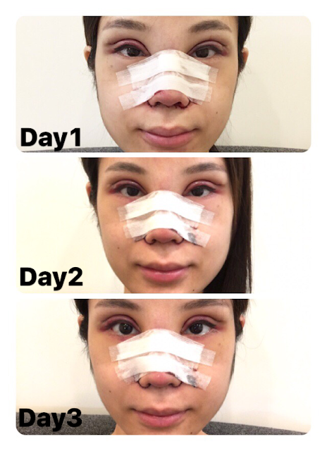 rhinoplasty nose eyelids epi epicanthoplasty zhongxiao dunhua zhongxiaodonglu