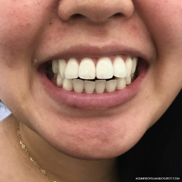 After Photo for Smile Brilliant Teeth Whitening Review - Andrea Tiffany A Glimpse of Glam