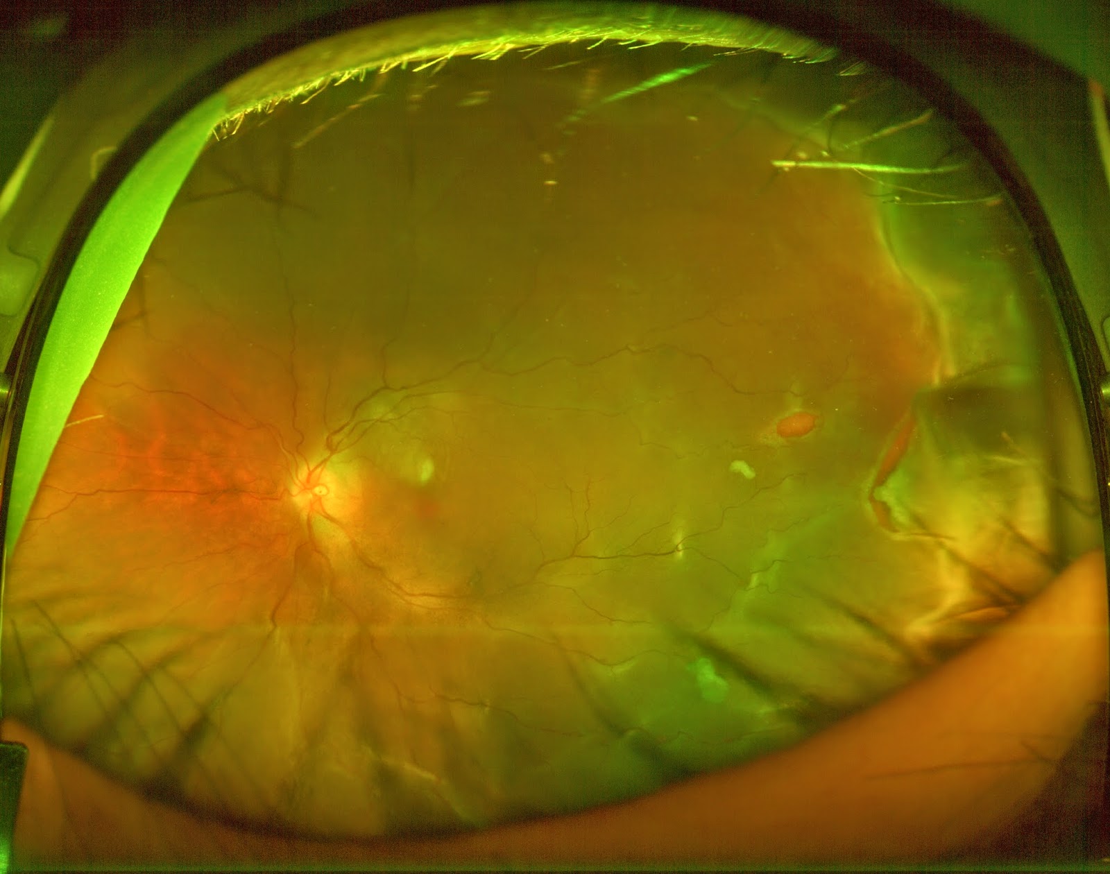 detached retina photo detached retina photo