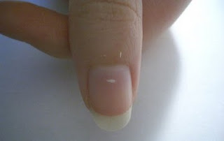 leuconiquia, manchas blancas uñas