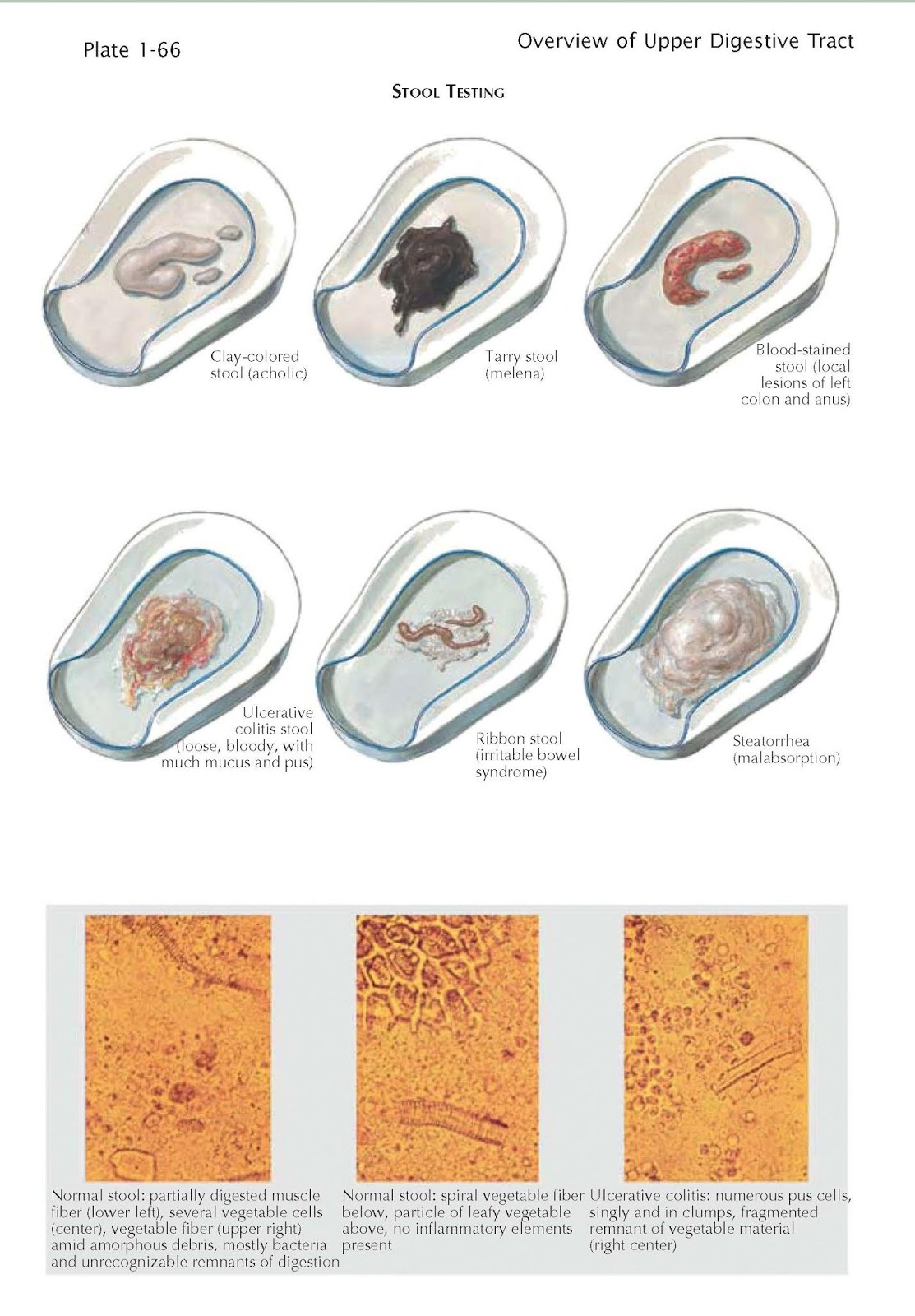 Blood Stained Stool - Stools Item