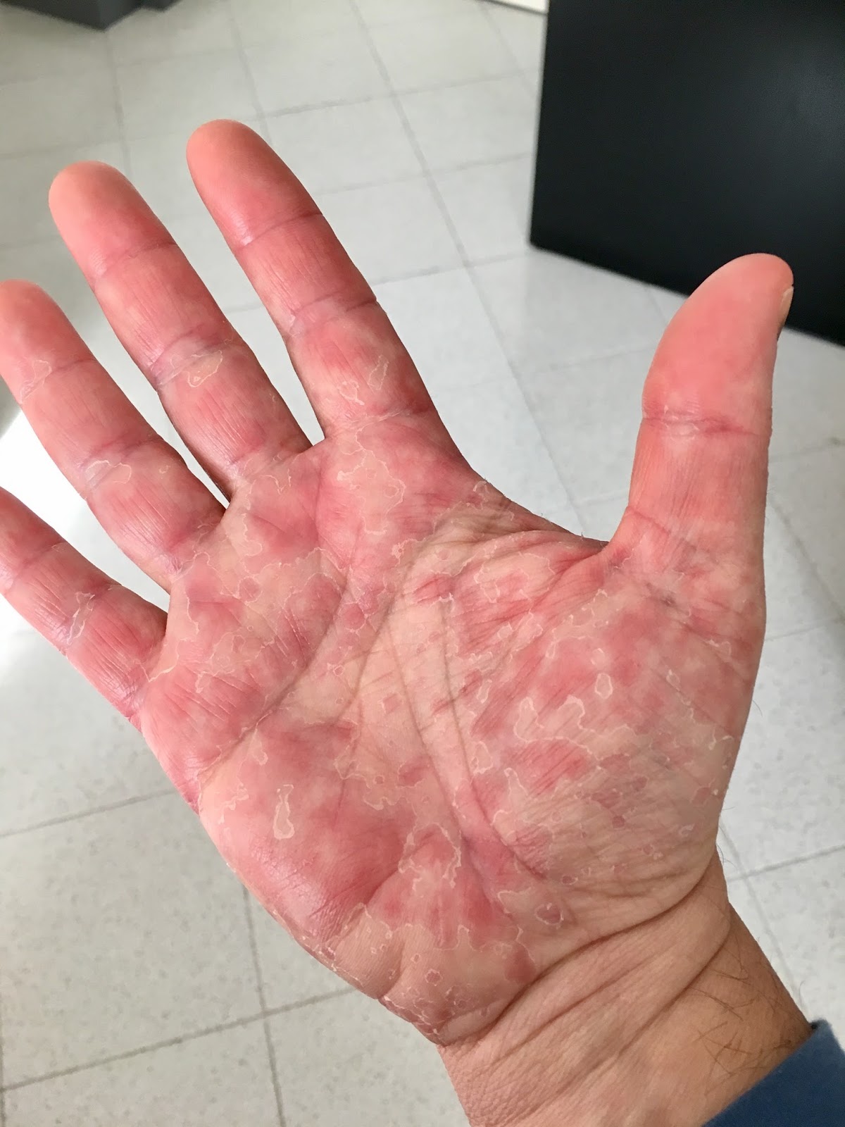 puntini rossi sul dorso della mano puntini rossi sul dorso della mano