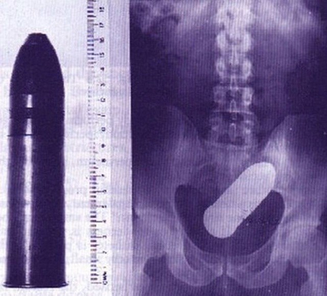 De anel a vibrador: veja os 6 objetos mais estranhos já encontrados em raios X De anel a vibrador: veja os 6 objetos mais estranhos já encontrados em raios X