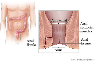 https://www.gastrosurgeoncochin.com/fistula-in-ano.html