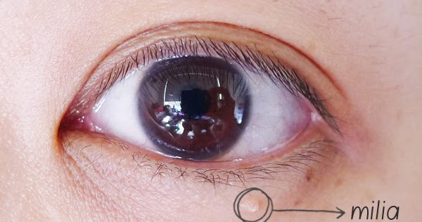 eye cream untuk milia