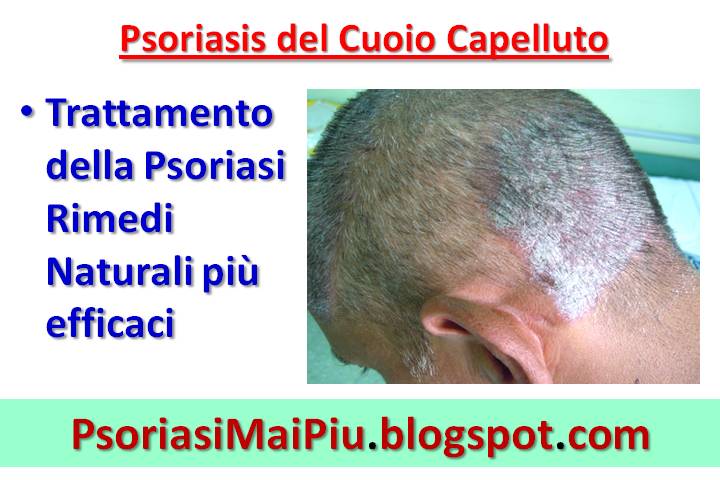 Come liberarsi da eczema di spazzole