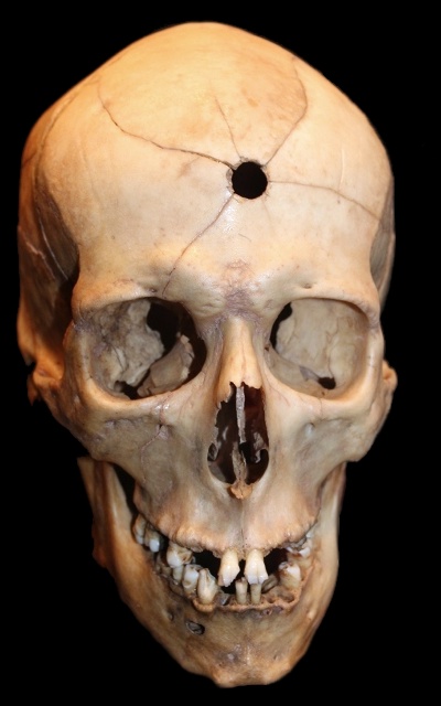 Smithsonian, skull with gunshot hole
