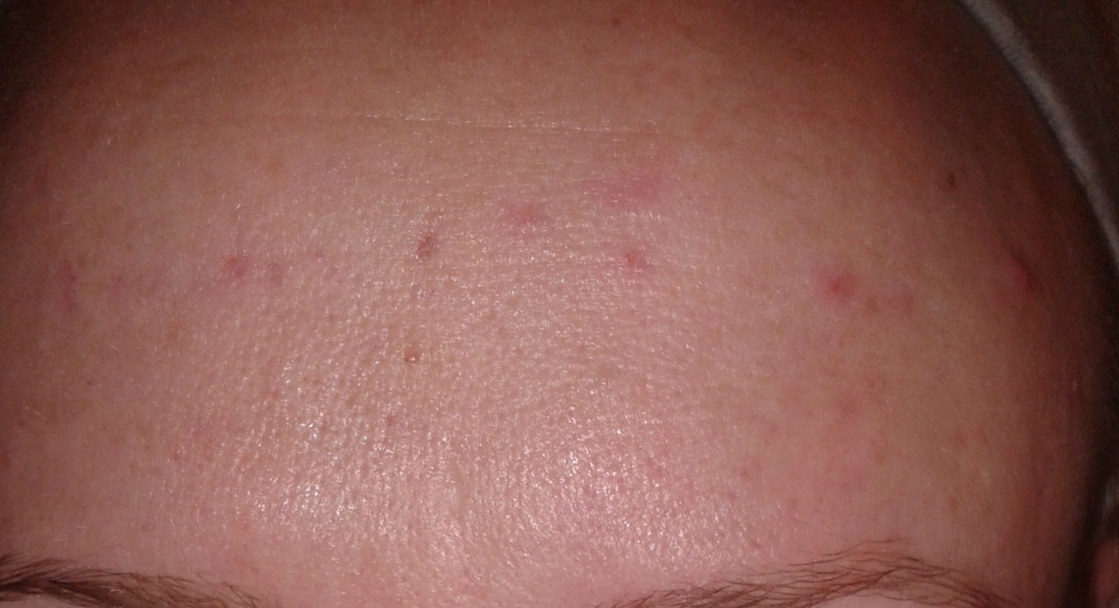 Mesotherapy For Acne