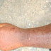 JEALOUS MAN CHOPS OFF EX-GIRLFRIEND’S HAND IN GHANA (PHOTO)