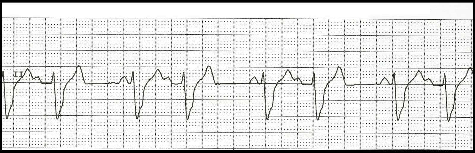 ECG Rhythm Strip Quiz 99 Heart blocks