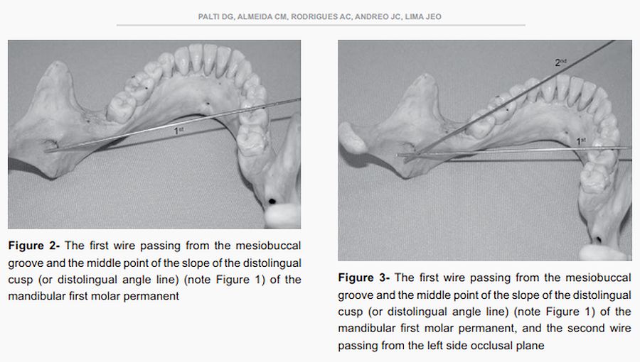 PDF Anesthetic technique for inferior alveolar nerve block a new