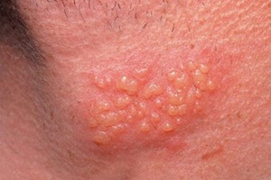 herpes di leher herpes di leher