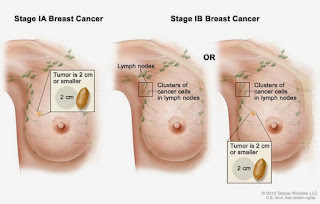  स्तन कैंसर का कारण बनता है, ब्रेस्ट कैंसर का इलाज, ब्रेस्ट कैंसर कैसे होता है, ब्रेस्ट में दर्द, ब्रेस्ट में गांठ, प्रोस्टेट कैंसर, सिम्पटम्स ऑफ़ ब्रैस्ट कैंसर, ब्रैस्ट कैंसर स्टेजेस, ब्रेस्ट कैंसर स्टेजेस
