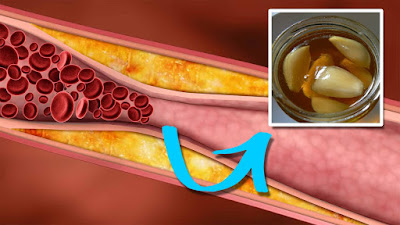 Potion That Reduces The Level Of Bad Cholesterol in The Blood Potion That Reduces The Level Of Bad Cholesterol in The Blood