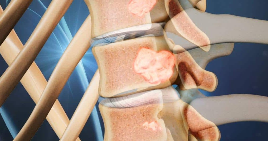 Spinal Cancer Life Expectancy CancerOz