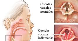 las cuerdas vocales inflamadas
