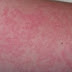 How Do You Prevent A Skin Rash From Sun Allergy (Photosensitivity)?