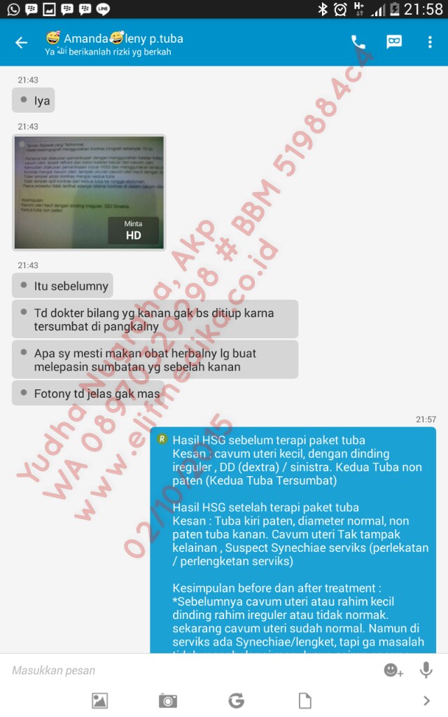 Testimoni Tuba Non Paten Bilateral Setelah Treatment 1 bulan, salah satu tuba sudah terbuka / paten Testimoni Tuba Non Paten Bilateral Setelah Treatment 1 bulan, salah satu tuba sudah terbuka / paten