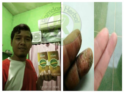 Pengobatan Kulit Bersisik, Kering Dan Gatal (Psoriasis)