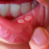 Everyone Should Be Aware Of This Early Signs Of "SINGAW" Mouth Sore Most People Ignore