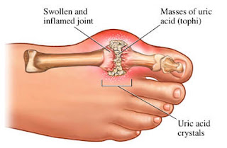 vitamin shaklee untuk penyakit gout