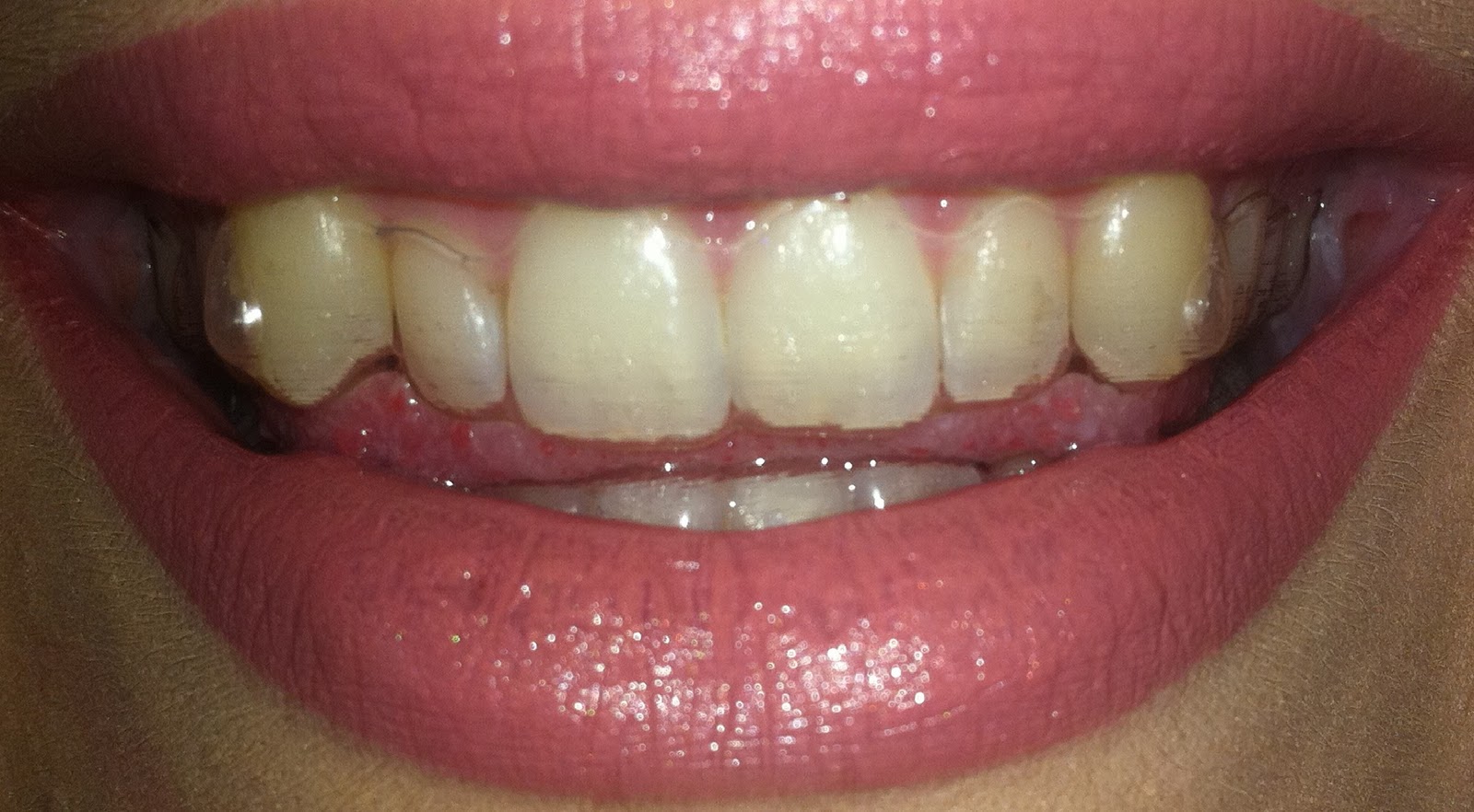 Shona's Invisalign Blog First day with Invisalign / Pictures with