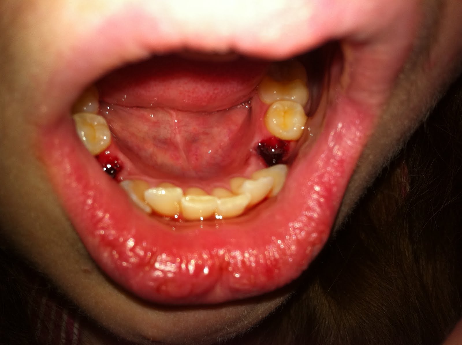 Fixing My Smile: Removal of my bicuspids