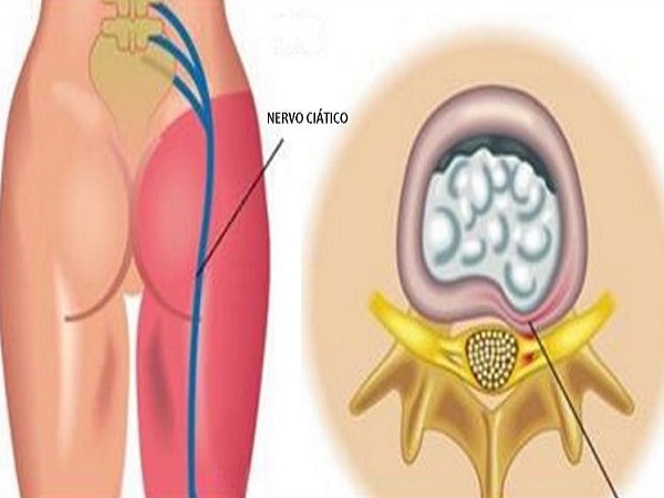 você pode curar dor no nervo ciático