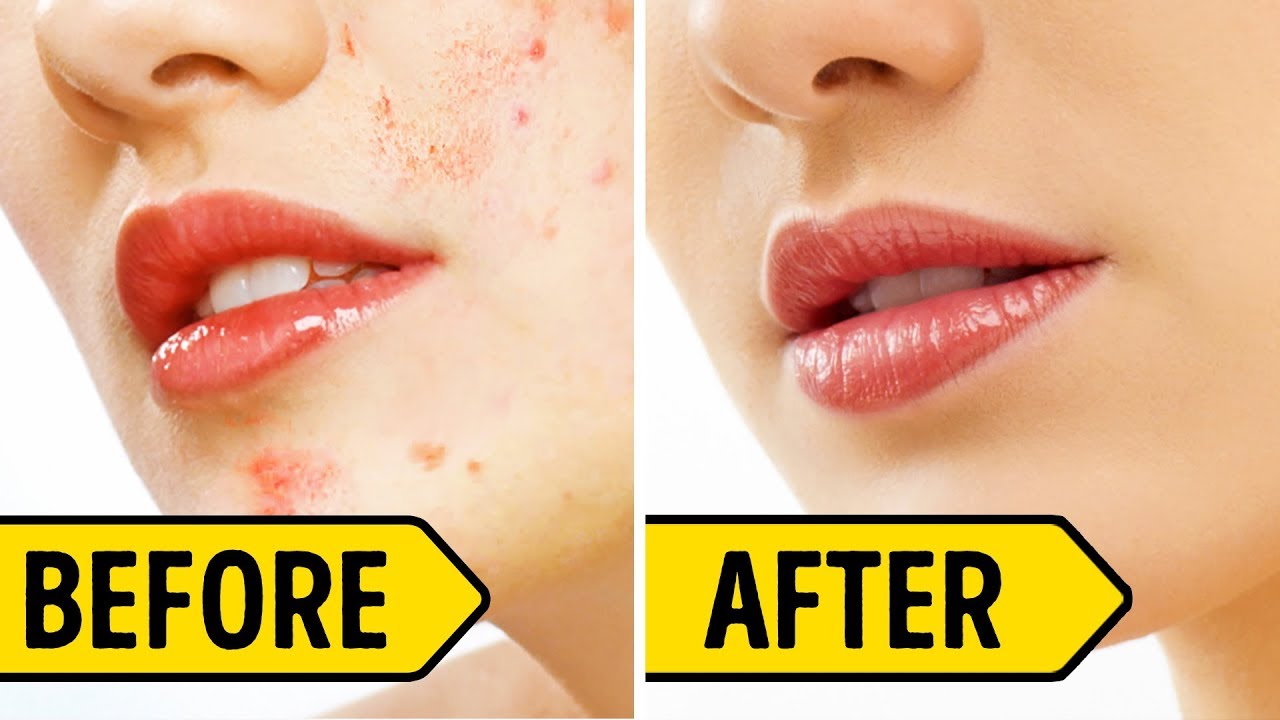 8 Effective Ways To Get Rid Of Acne Scars And Dark Spots LifeStyle Wikis