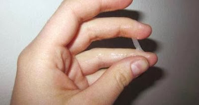 Nanah Terus Keluar Dari Penis Dan Cara Mengobatinya Nanah Terus Keluar Dari Penis Dan Cara Mengobatinya