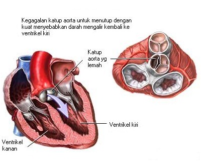 Ciri Ciri,Gejala,Penyebab Penyakit Jantung & Obat Herbalnya Ciri Ciri,Gejala,Penyebab Penyakit Jantung & Obat Herbalnya
