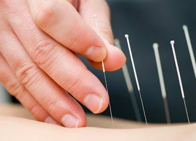 cách chữa trị rụng tóc bằng phương pháp châm cứu cách chữa trị rụng tóc bằng phương pháp châm cứu