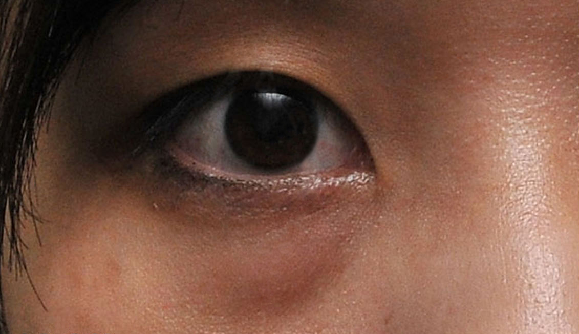 Confessions Of A Beauty Addict My Dark Eye Circles & Eyebag Treatment