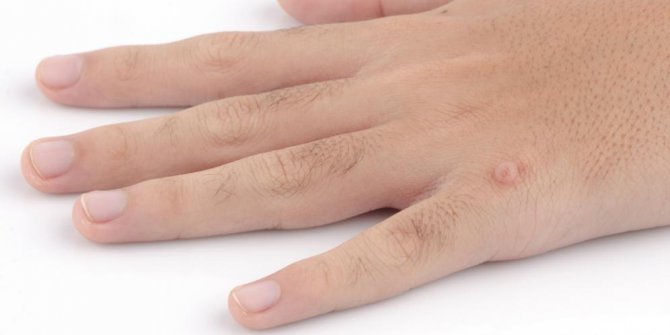 Cara Menghilangkan Kutil Cepat Secara Alami