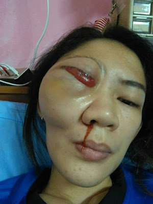 graphic pics of young woman s eye popping out of her head due to