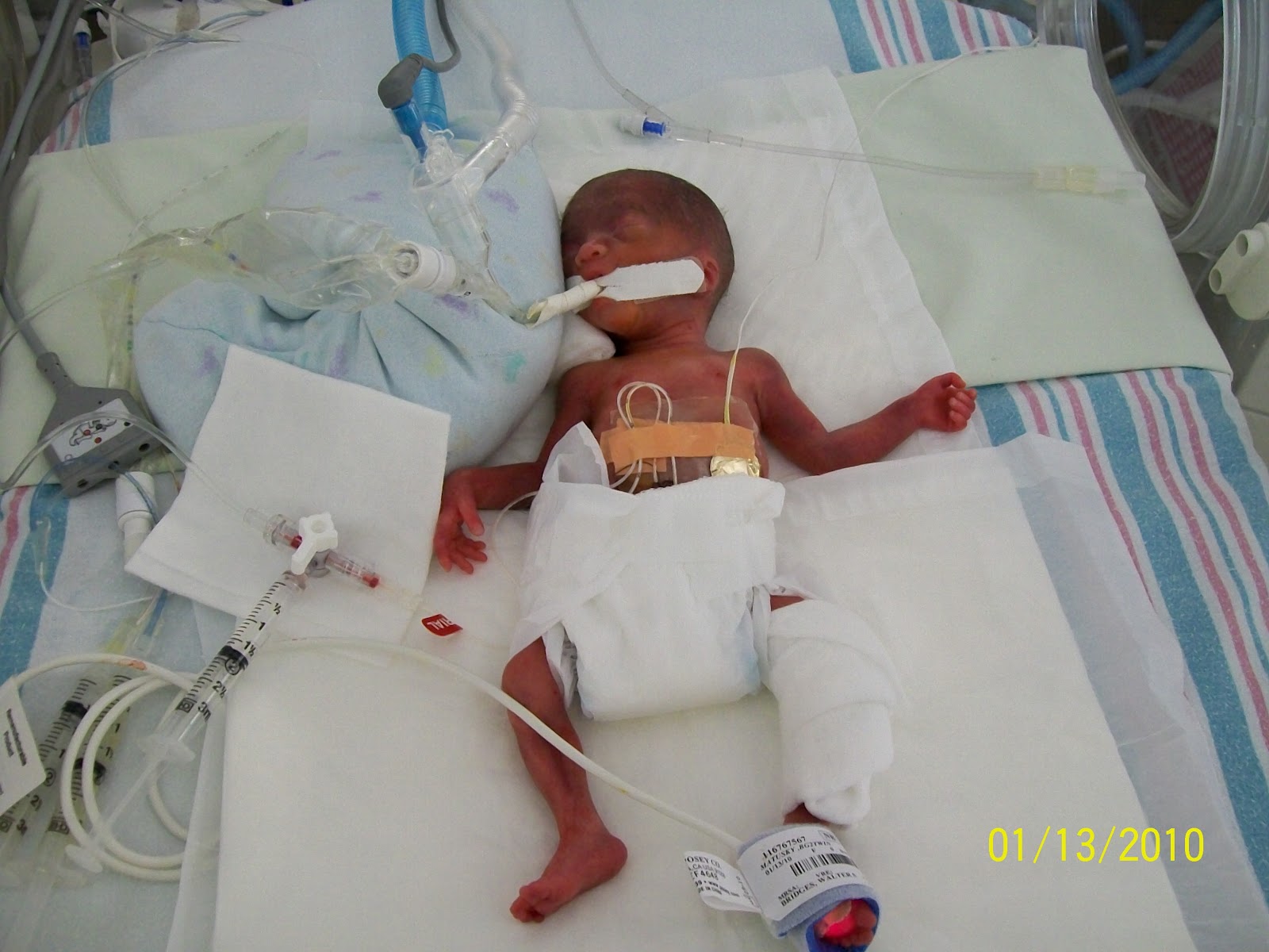 24 Weekers And Other Preemie Babies Pictures Day 1 1 Pound 4 Oz Each