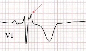 Epsilon Waves