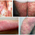Obat Gatal Scabies Terbukti Paling Ampuh Sangat Manjur Di Apotik