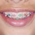 Hukum Memakai Pendakap Gigi / Braces Dalam Islam. KETAHUINYA DENGAN BACA DISINI