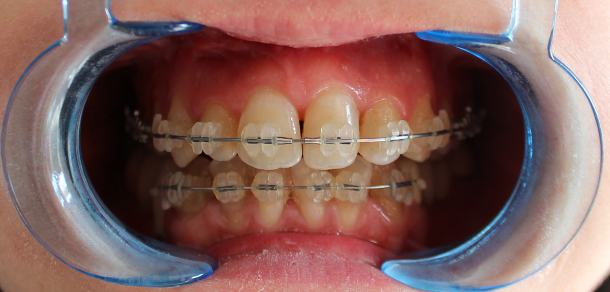 Orthodontie adulte bouche en chantier décembre 2016