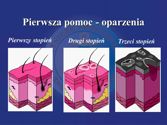Opisz Pierwsza Pomoc W Przypadku Oparzenia Słonecznego Skóry Brainly OPARZENIA - Pierwsza Pomoc - Krzątająca Kobieta Wychowująca