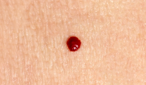 Cherry Angioma Removal Hemangioma Campbell De Morgan Spots 