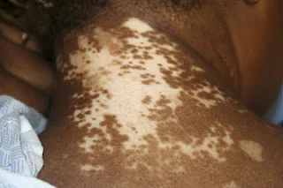 El cuello de uno de los pacientes con vitíligo antes del injerto