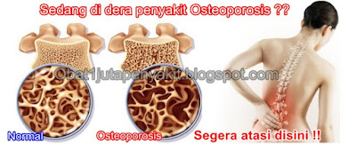 Obat Herbal Osteoporosis ini TERUJI & TERBUKTI MANJUR Menyembuhkan Osteoporosis Obat Herbal Osteoporosis ini TERUJI & TERBUKTI MANJUR Menyembuhkan Osteoporosis
