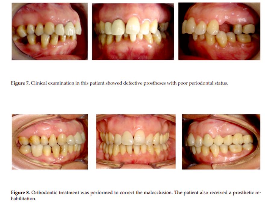 PDF Periodontal Health and Orthodontics