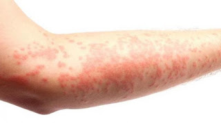 obat gatal jenis alergi paling ampuh